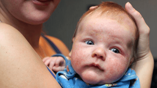 How to Get Rid of Eczema Scars on Babies